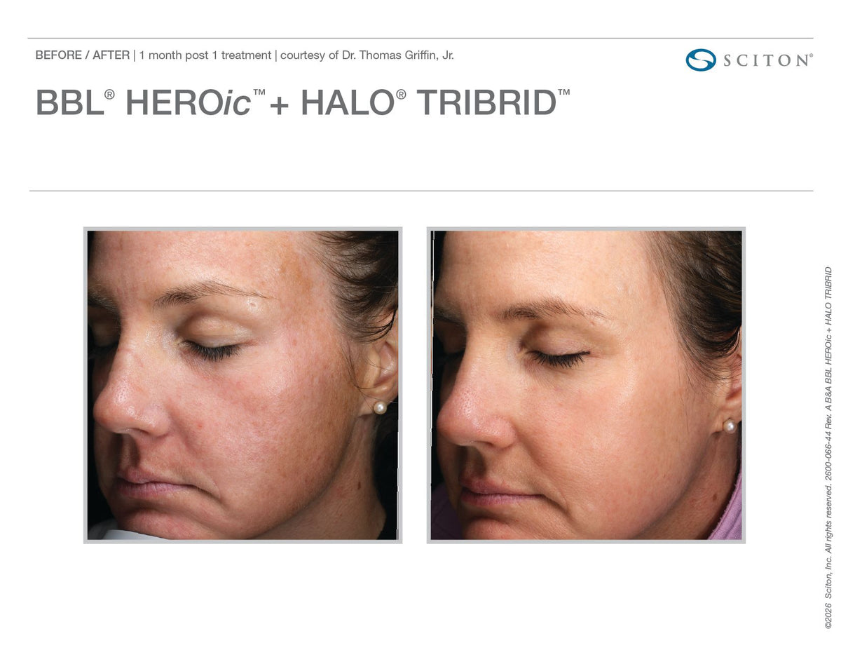 Sciton Tribrid Laser-Ultimate Skin Renewal ADD ON BODY AREAS - Renew Wellness & Aesthetics