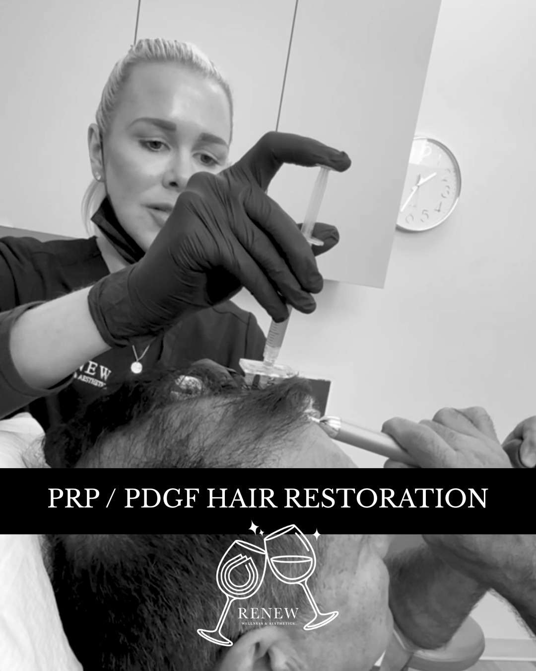 PRP - PDGF Hair Restoration - Renew Wellness & Aesthetics