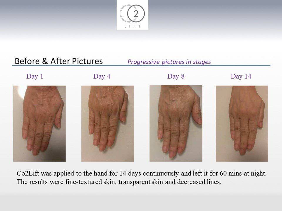 CO2Lift® Pro Carboxy Gel Masks - 3 Home TreatmentsAnti - Aging - Renew Wellness & Aesthetics
