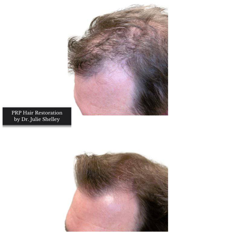 PRP Hair RestorationProcedure - Renew Wellness & Aesthetics