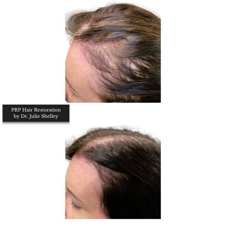 PRP Hair RestorationProcedure - Renew Wellness & Aesthetics