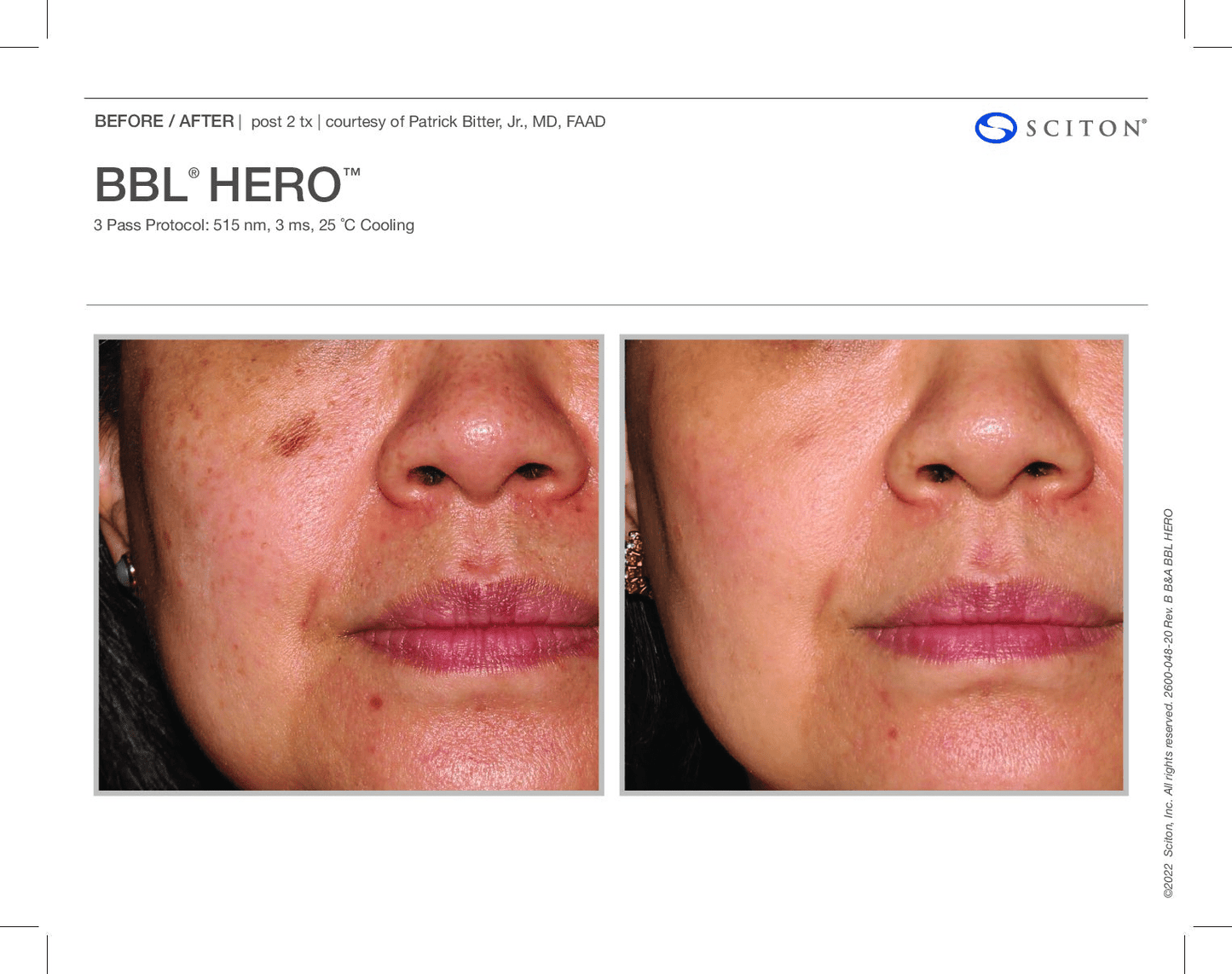 BBL Hero - Renew Wellness & Aesthetics