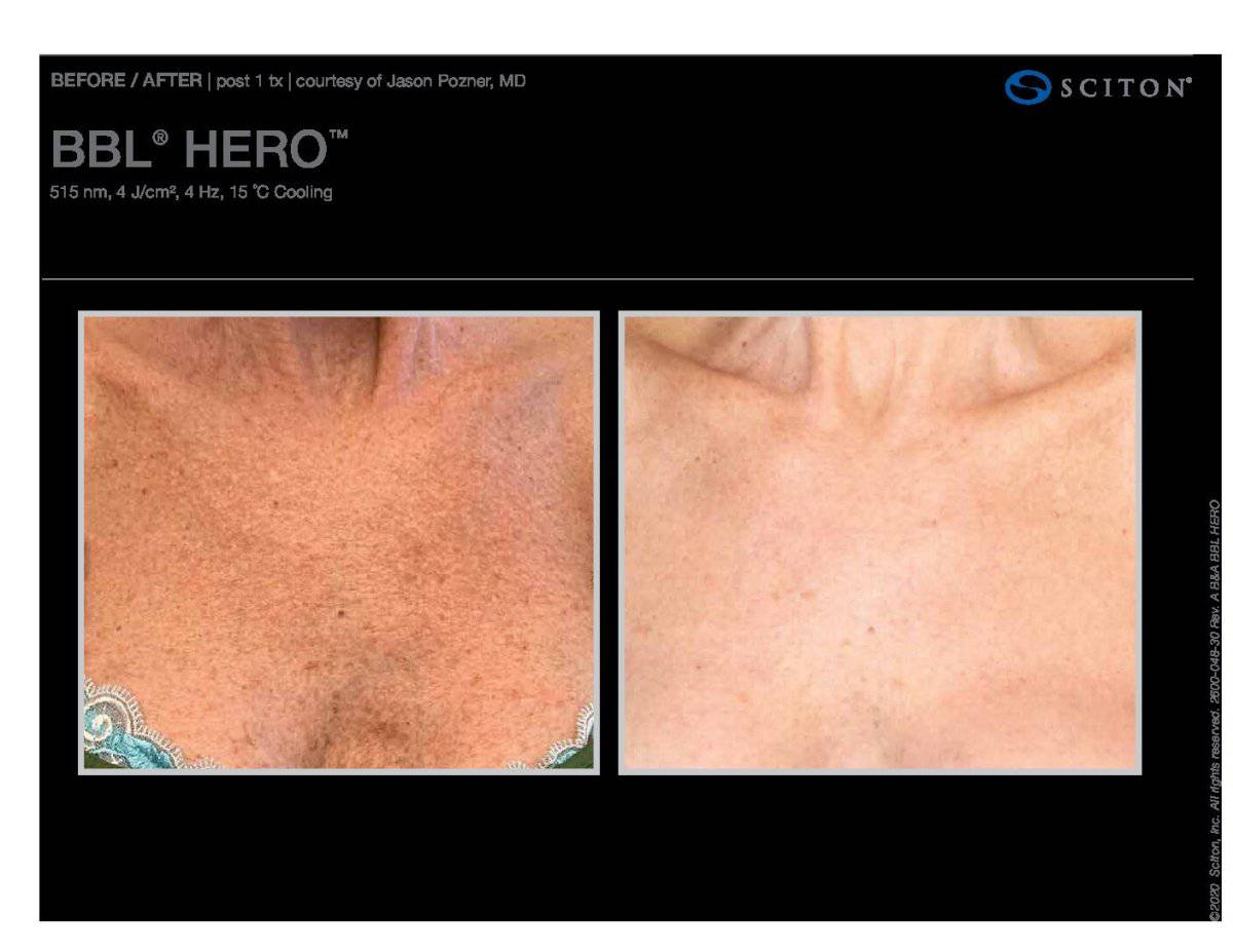 BBL HeroProcedure - Renew Wellness & Aesthetics