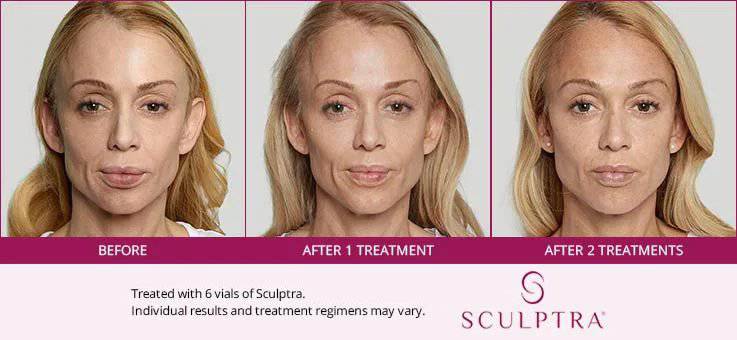 Sculptra - Renew Wellness & Aesthetics