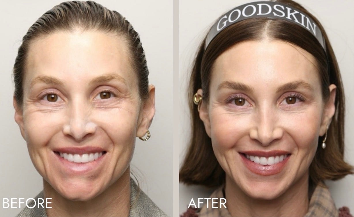 Volume Renewal - Non Surgical Fat Transfer (Renuva)