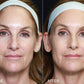 Volume Renewal - Non Surgical Fat Transfer (Renuva)