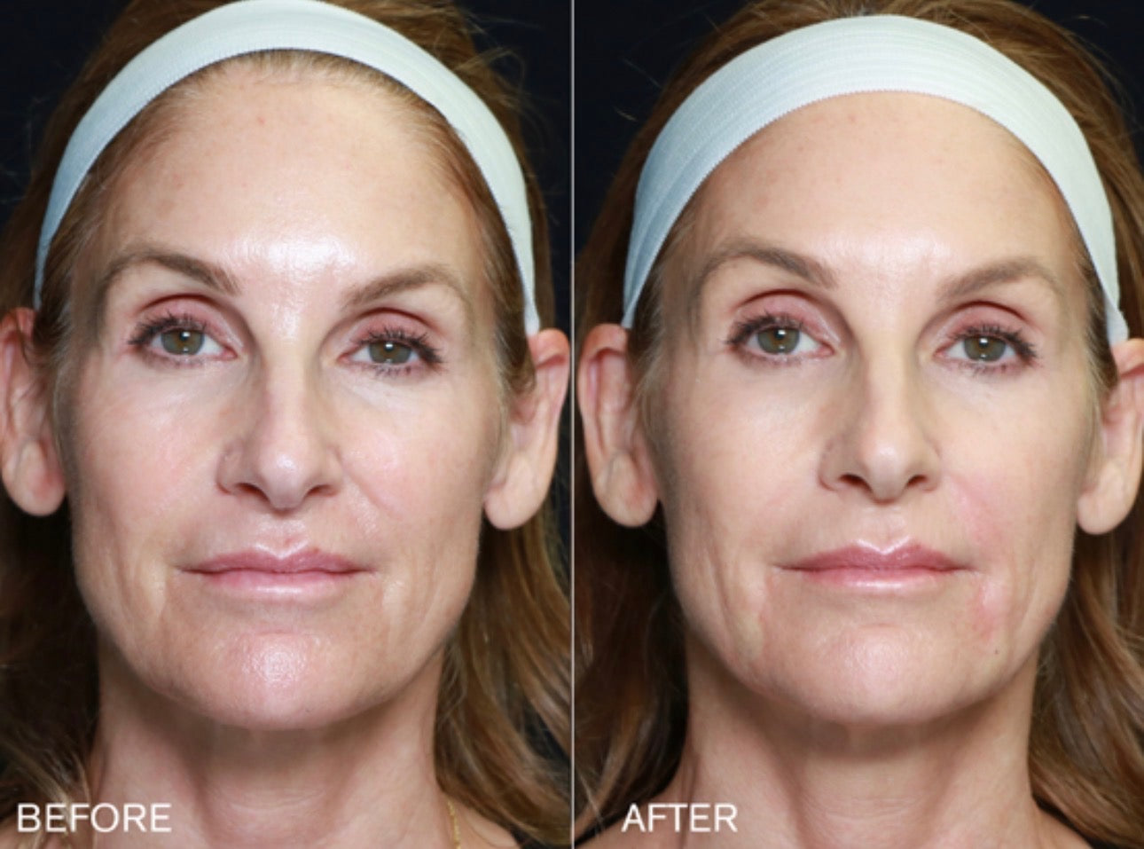 Volume Renewal - Non Surgical Fat Transfer (Renuva)