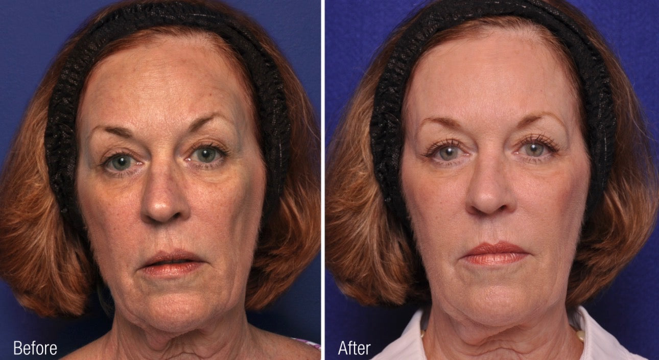 Volume Renewal - Non Surgical Fat Transfer (Renuva)