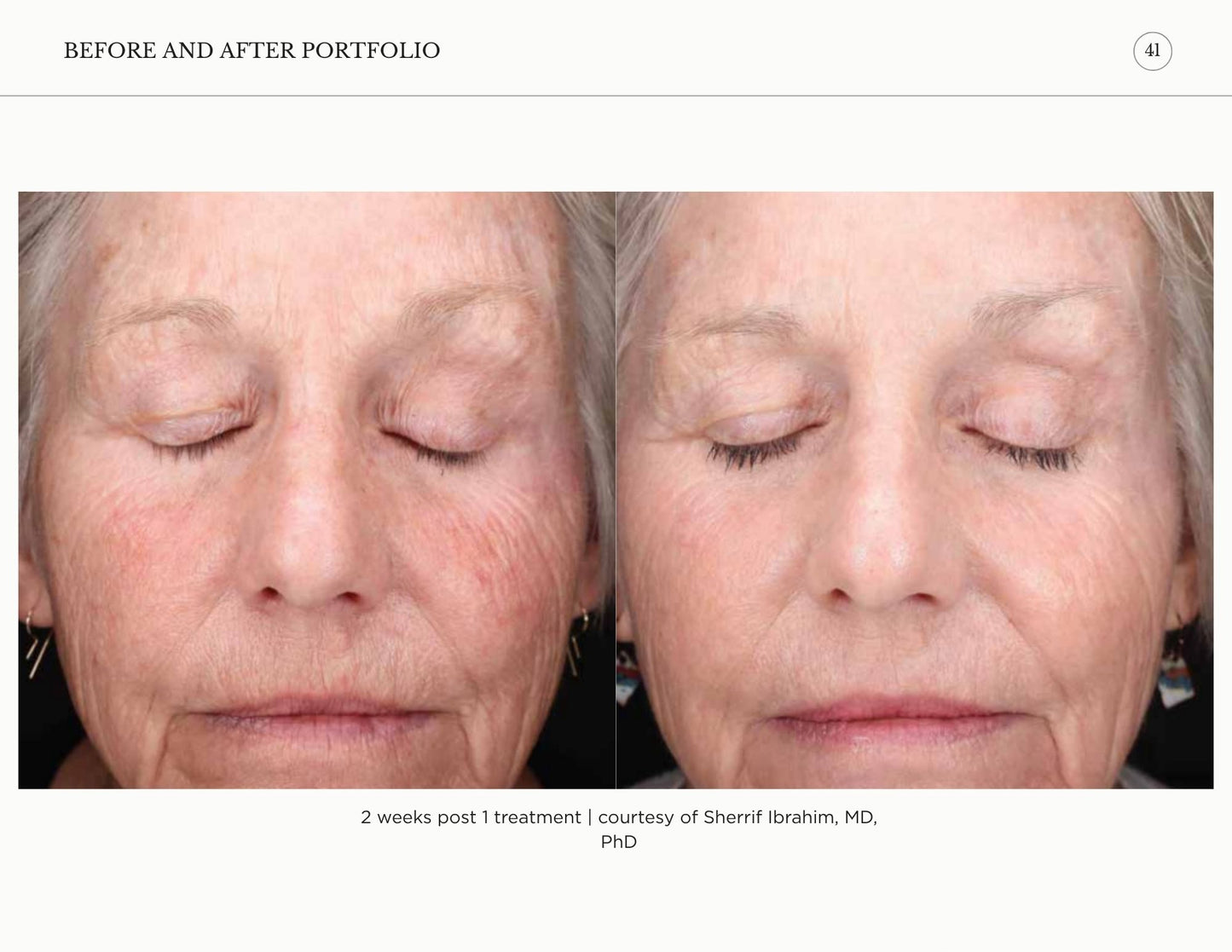 Sciton Tribrid Laser-Ultimate Skin Renewal