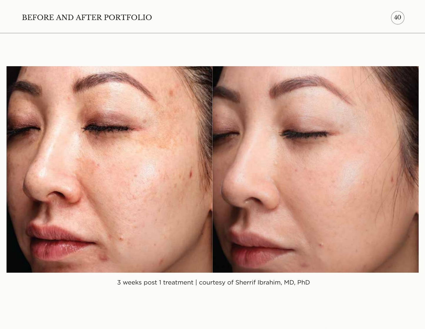 Sciton Tribrid Laser-Ultimate Skin Renewal