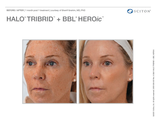 Sciton Tribrid Laser-Ultimate Skin Renewal