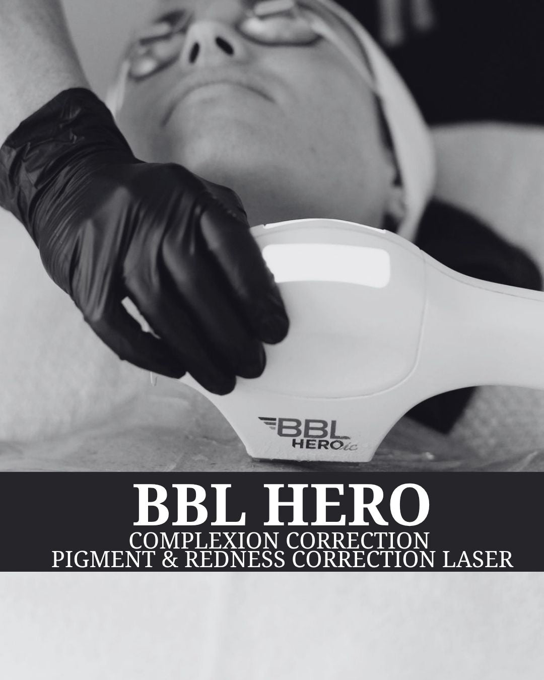 Complexion Correction - BBL Hero - Renew Wellness & Aesthetics 