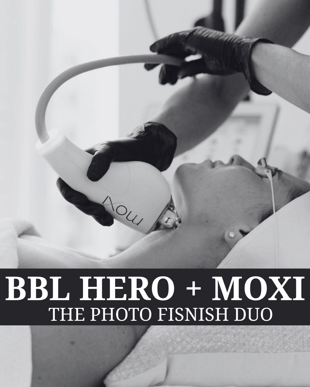 The Photo Finish Duo - BBL Hero + Moxi - Renew Wellness & Aesthetics 