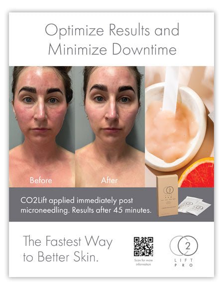 CO2Lift® Pro Carboxy Gel Masks - 3 Home TreatmentsAnti - Aging - Renew Wellness & Aesthetics