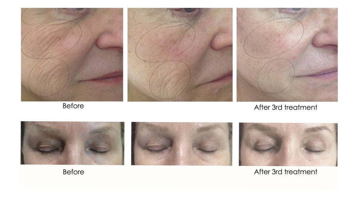 CO2Lift® Pro Carboxy Gel Masks - 3 Home TreatmentsAnti - Aging - Renew Wellness & Aesthetics