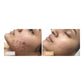 Omnilux Clear for Acne LED Therapy DeviceAcne Treatment - Renew Wellness & Aesthetics