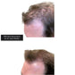 PRP Hair RestorationProcedure - Renew Wellness & Aesthetics