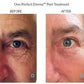 The Perfect Derma PeelProcedure - Renew Wellness & Aesthetics