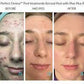 The Perfect Derma PeelProcedure - Renew Wellness & Aesthetics