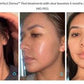 The Perfect Derma PeelProcedure - Renew Wellness & Aesthetics
