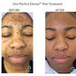 The Perfect Derma PeelProcedure - Renew Wellness & Aesthetics