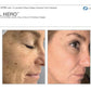 BBL HeroProcedure - Renew Wellness & Aesthetics
