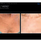BBL HeroProcedure - Renew Wellness & Aesthetics