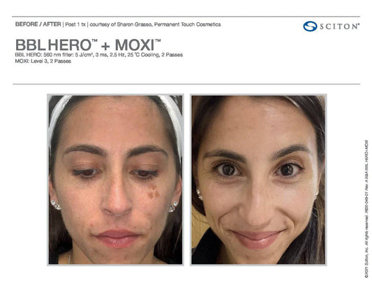 BBL Hero + MoxiProcedure - Renew Wellness & Aesthetics
