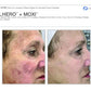 BBL Hero + MoxiProcedure - Renew Wellness & Aesthetics