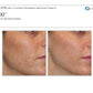 MoxiProcedure - Renew Wellness & Aesthetics
