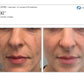 MoxiProcedure - Renew Wellness & Aesthetics
