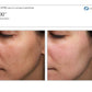 MoxiProcedure - Renew Wellness & Aesthetics