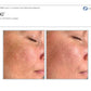 MoxiProcedure - Renew Wellness & Aesthetics