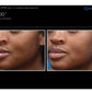 MoxiProcedure - Renew Wellness & Aesthetics