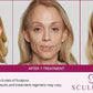 Sculptra - Renew Wellness & Aesthetics 